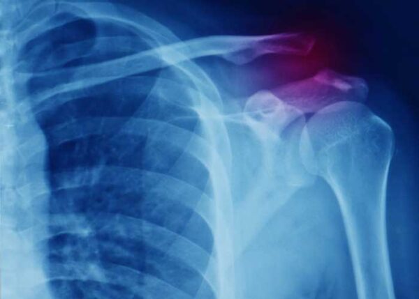 AC Joint Injury | Manhattan NY