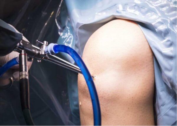 Knee Arthroscopy | Manhattan NY