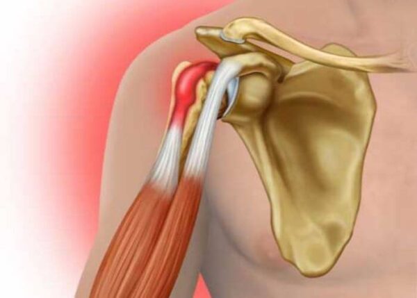 Biceps Tendon | Manhattan NY