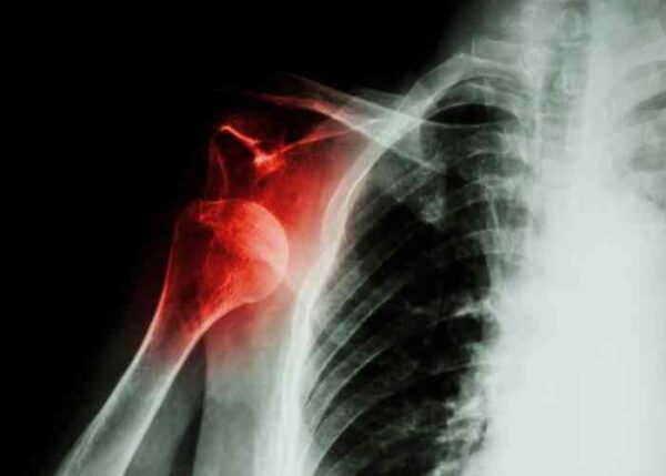 Shoulder Dislocation | Manhattan NY