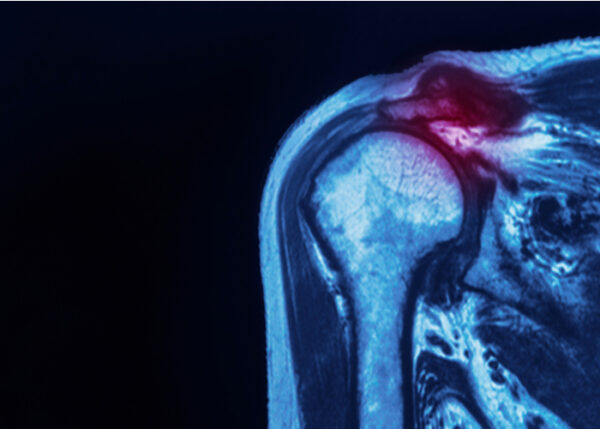 Labrum SLAP | Manhattan NY