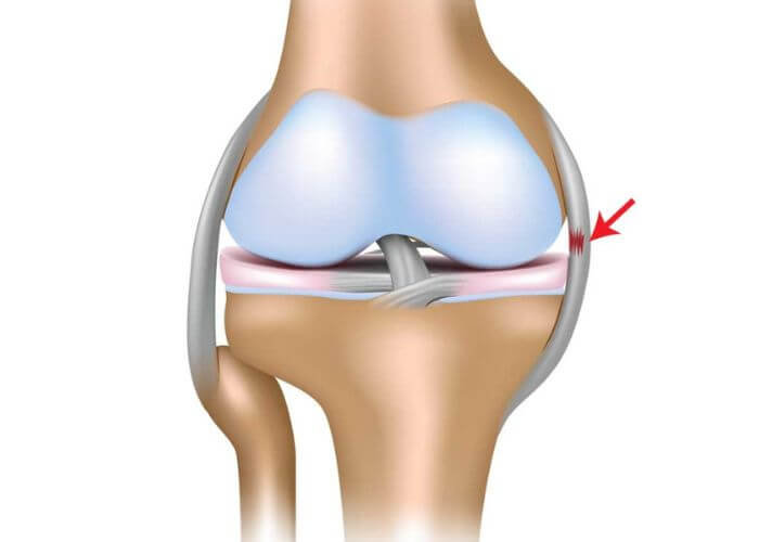 Arthroscopy Repair for Medial/Lateral Collateral Ligament Tears