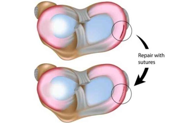 Meniscus Repair | Manhattan NY