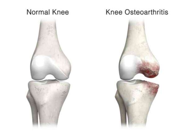 Osteoarthritis | Manhattan NY