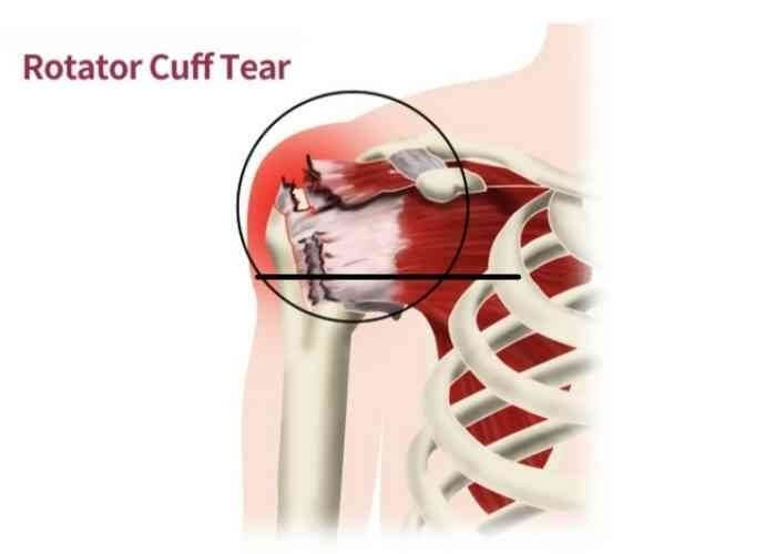 Rotator Cuff Tear | Manhattan NY