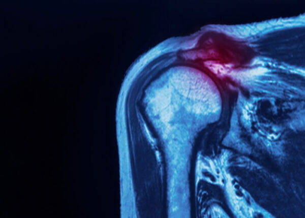 SLAP Tear | Manhattan NY