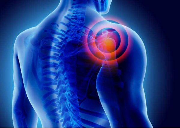 Shoulder Impingement | Manhattan NY