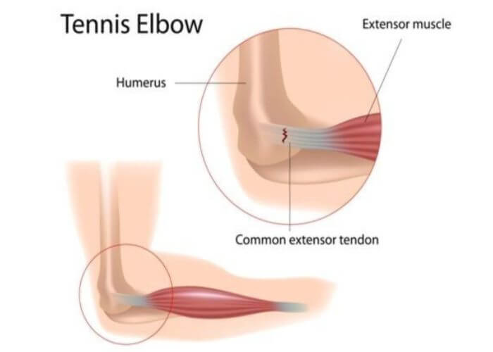 Tennis Elbow | Manhattan NY