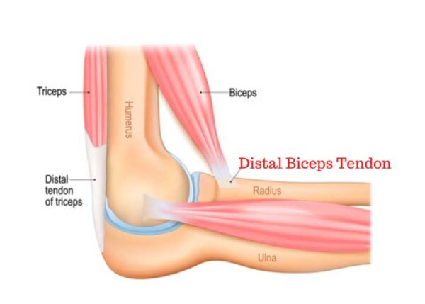 Distal Biceps Tendon | Manhattan NY